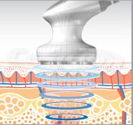 eunsung-lipozero-cavitation