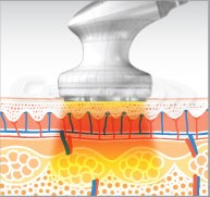 eunsung-lipozero-low-level-laser