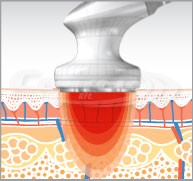 eunsung-lipozero-radiofrequency